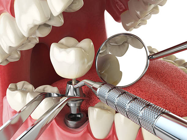 Best Emergency Root Canal Treatment in Oak Hills, OR