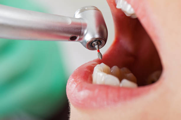 Best Emergency Tooth Extraction in Oak Hills, OR
